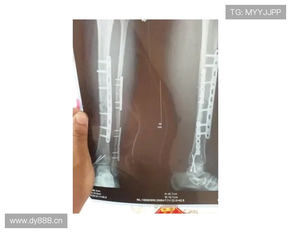 穆西亚拉左腓骨骨折且多条韧带受损预计伤缺四至五个月